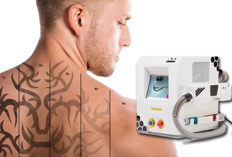 eliminación de tatuajes con láser INK HUNTER MASTER