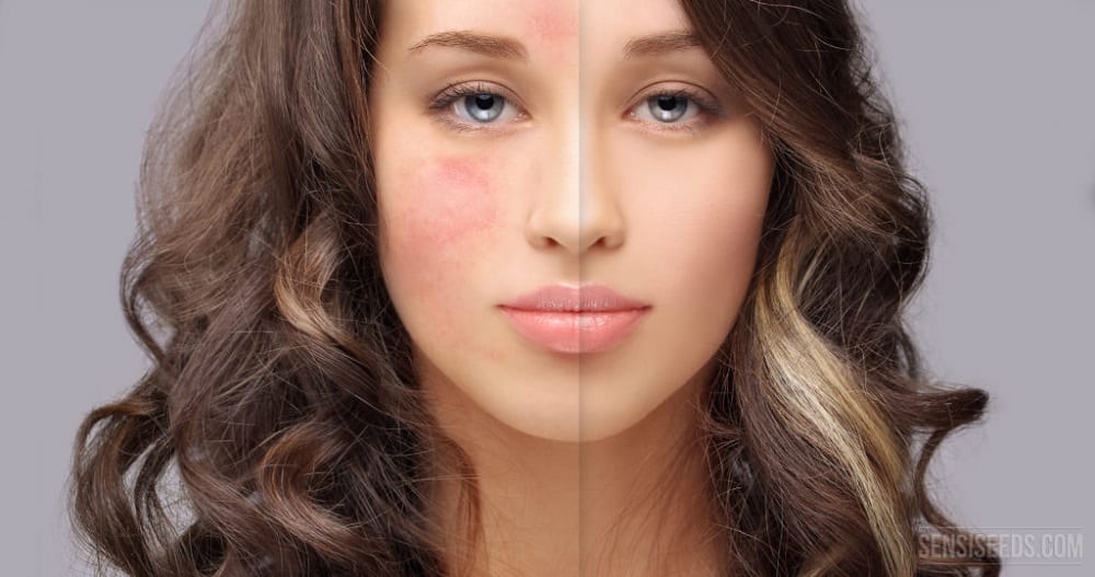 Venas rojas del rostro|Cuperosis tratamiento