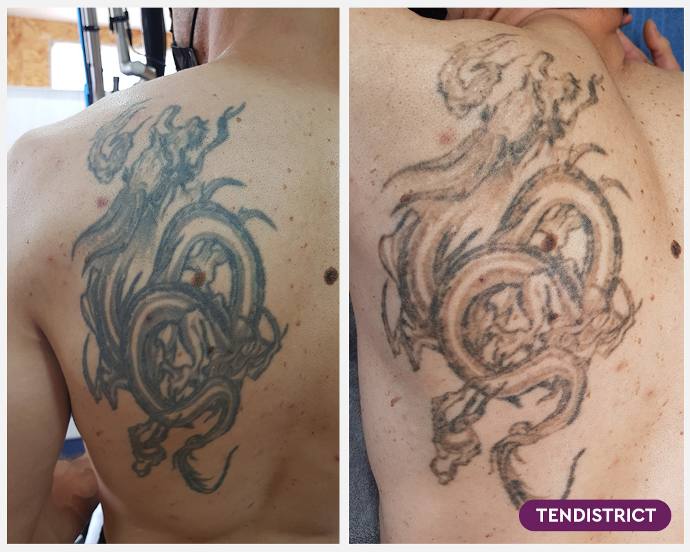 Imagen: Eliminación de tatuajes 1 sesión