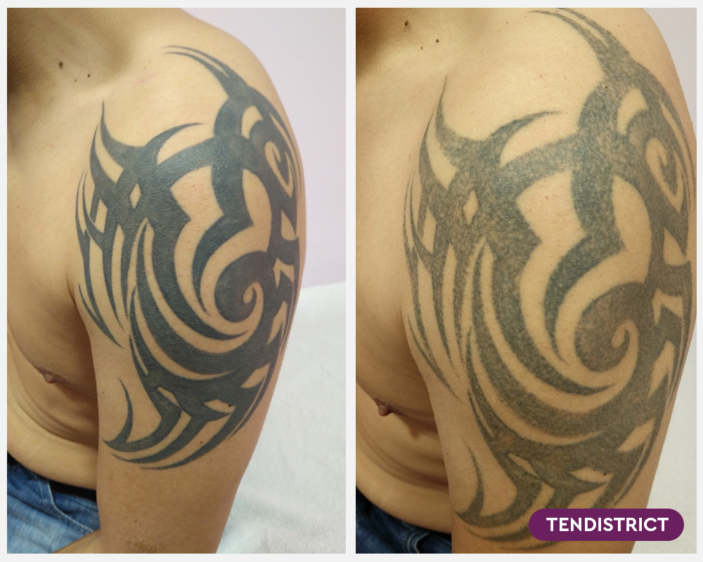 Imagen: Eliminación de tatuajes 1 sesión Foto 2