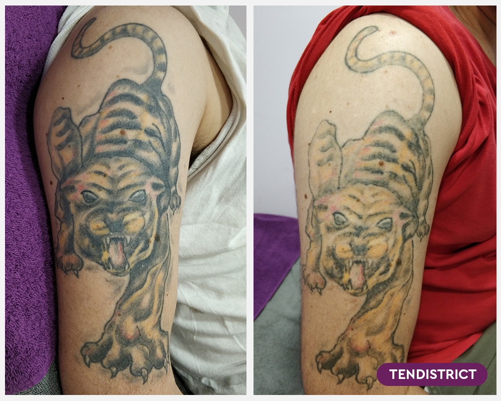 Imagen: Eliminación de tatuajes 1 sesión Foto 3