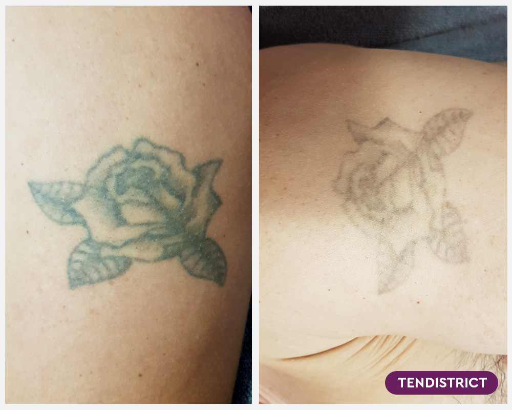 Imagen: Eliminación de tatuaje antes y después 2 sesiones Foto 1