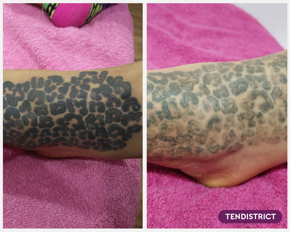 Imagen: Eliminación de tatuaje antes y después 2 sesiones Foto 2