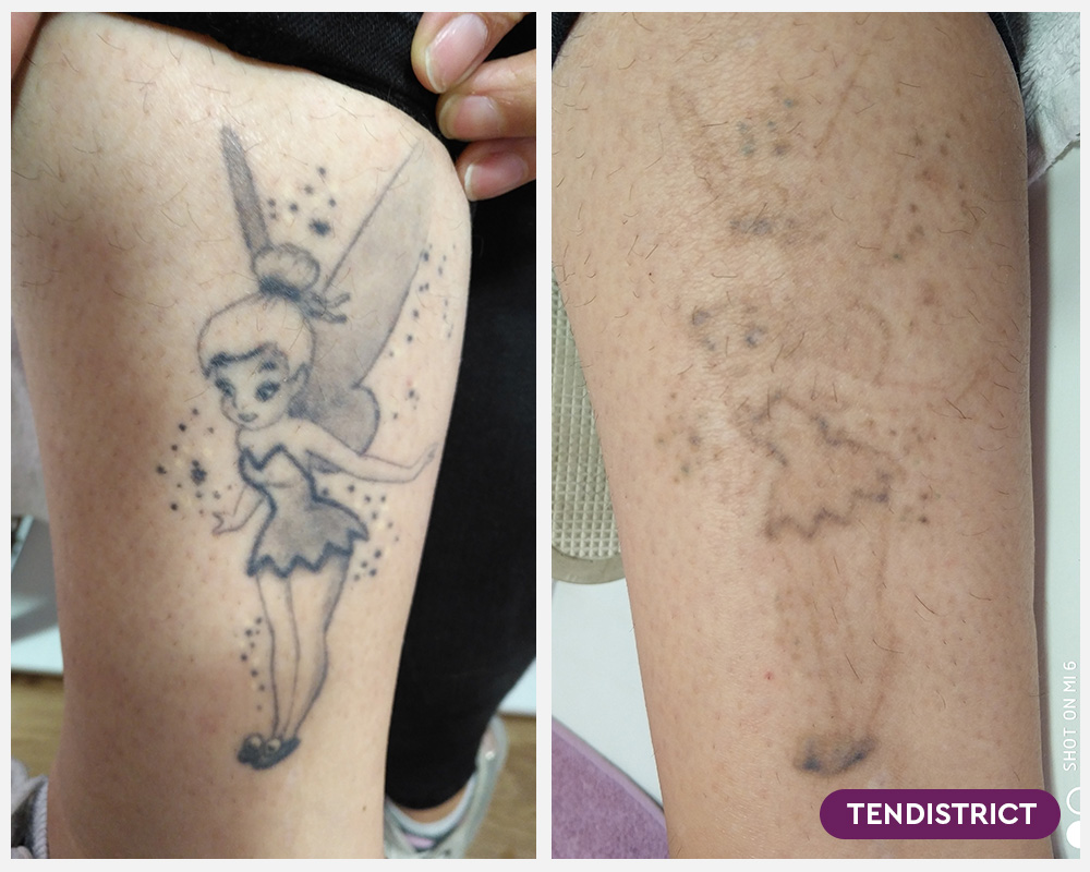 Imagen: Eliminación de tatuaje antes y después 2 sesiones Foto 3