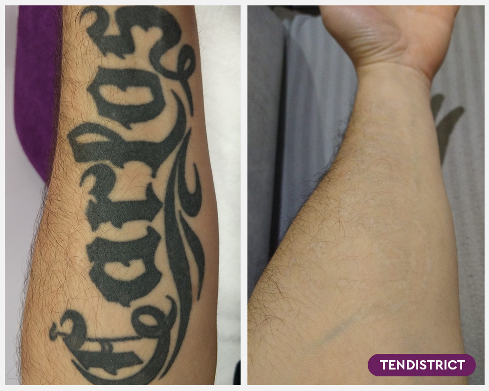 Imagen: Eliminación de tatuajes con más de 2 sesiones - Foto 1