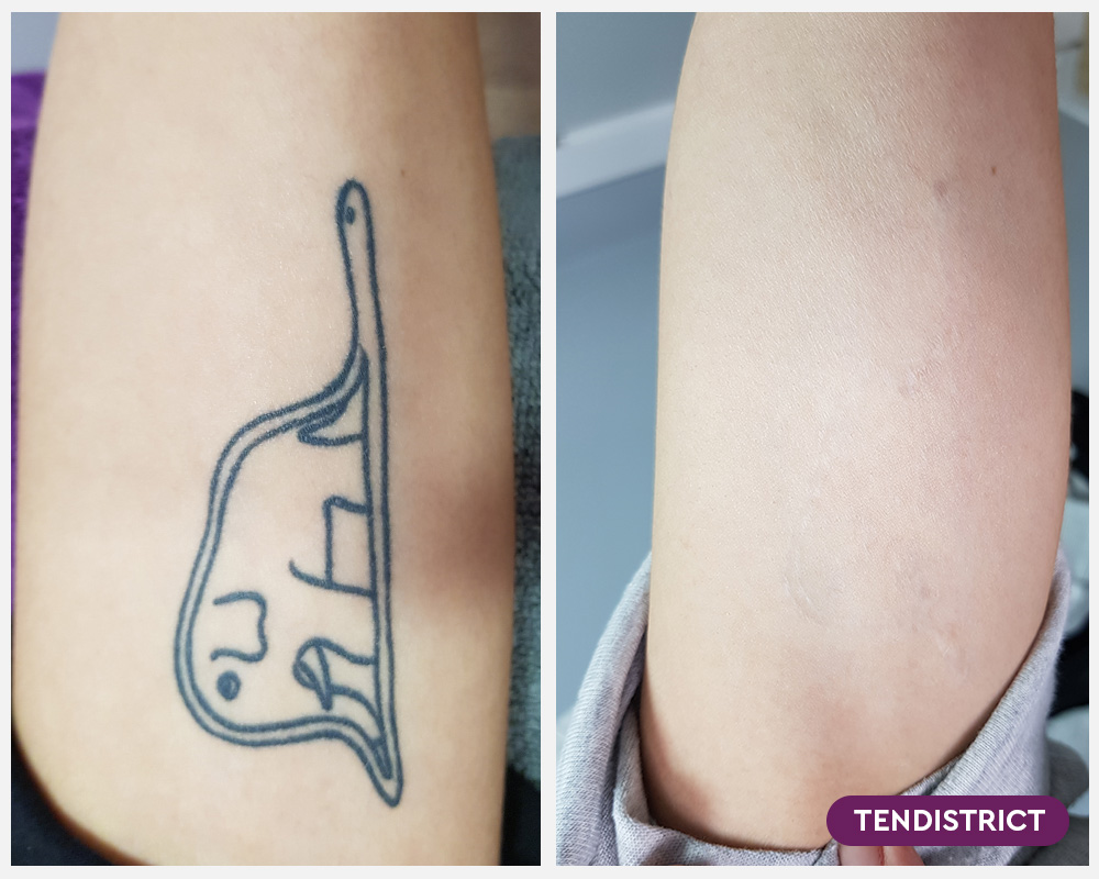 Imagen: Eliminación de tatuajes con más de 2 sesiones - Foto 2