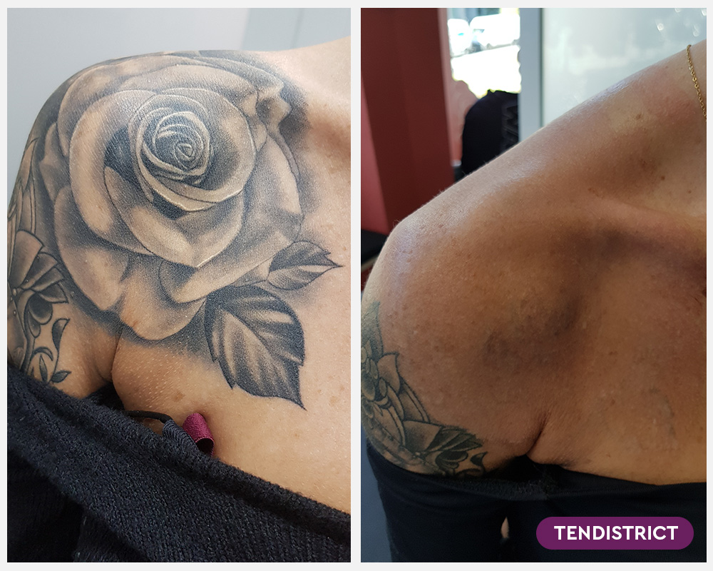 Imagen: Eliminación de tatuajes con más de 2 sesiones - Foto 3