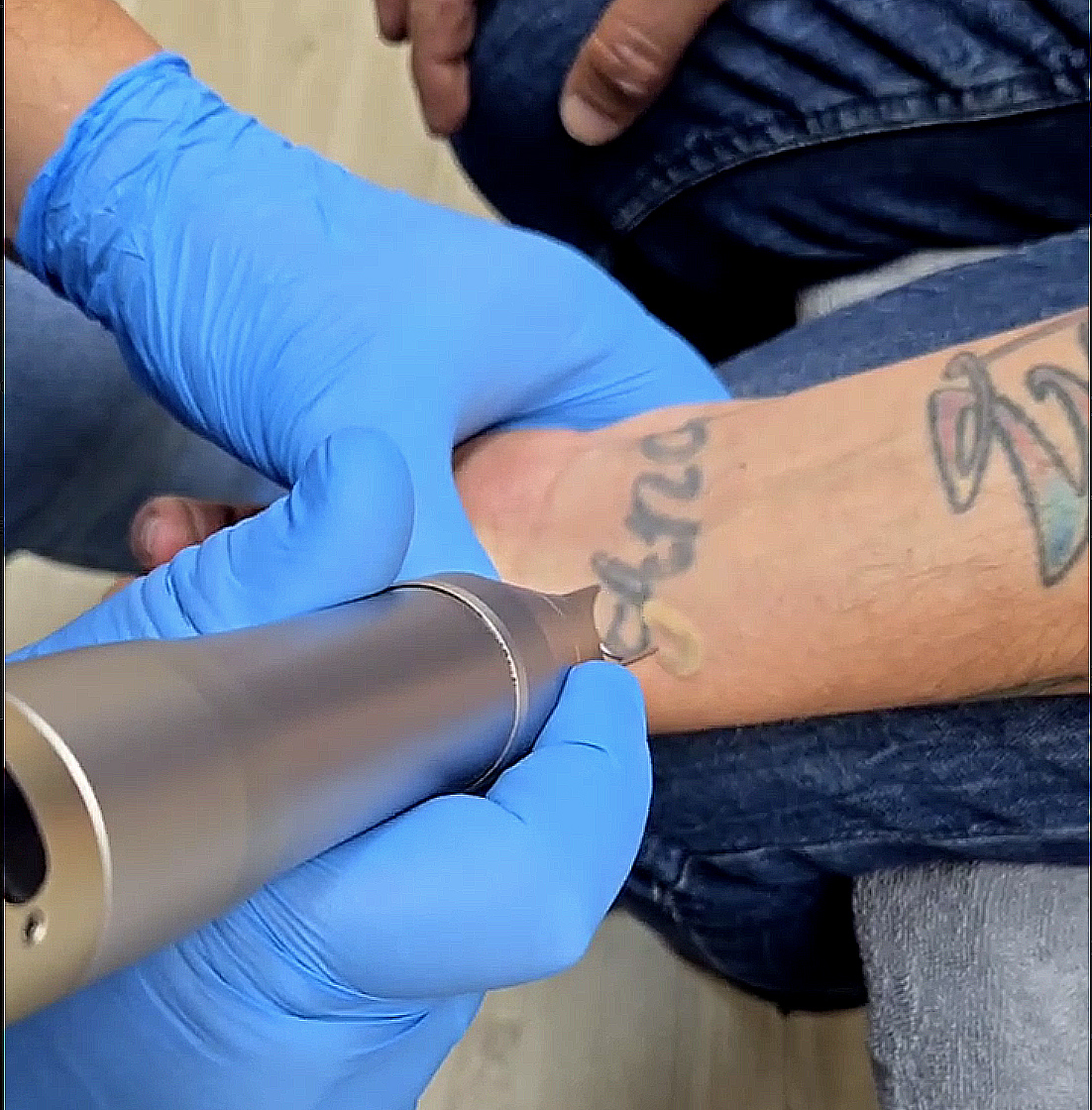 Imagen borrado de tatuajes en Lugo